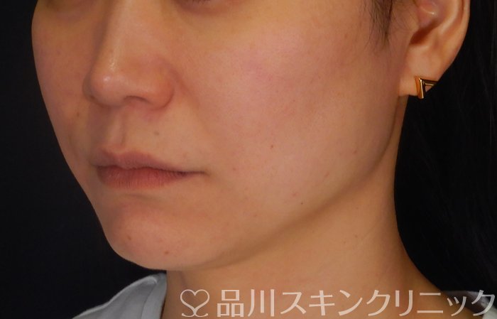症例NO.65676のAFTER写真
