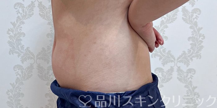 症例NO.69949のBEFORE写真