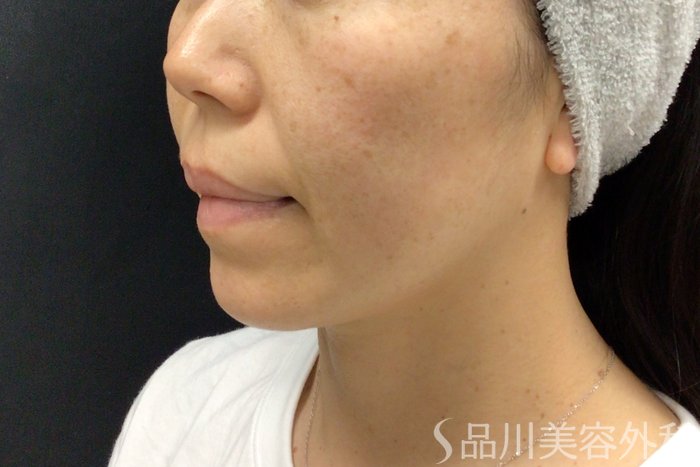 症例NO.71279のBEFORE写真