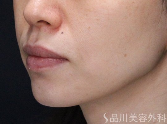 症例NO.73913のBEFORE写真