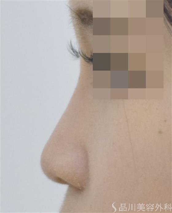 症例NO.50691のAFTER写真