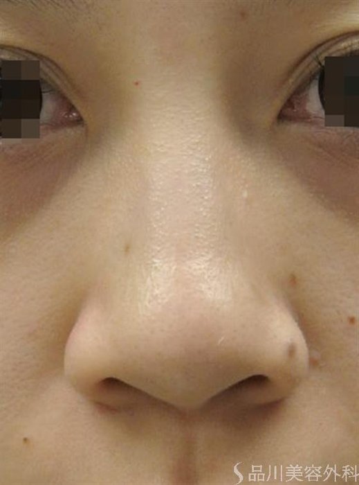症例NO.16430のBEFORE写真