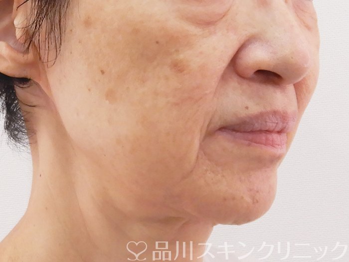 症例NO.62649のBEFORE写真
