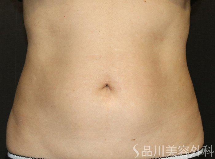 症例NO.69708のAFTER写真