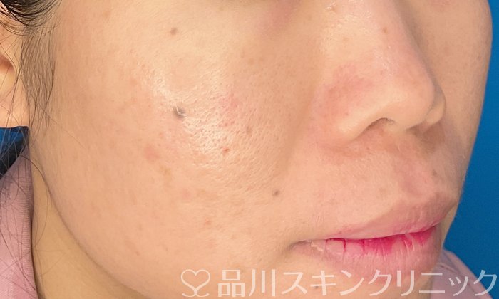 症例NO.72805のAFTER写真