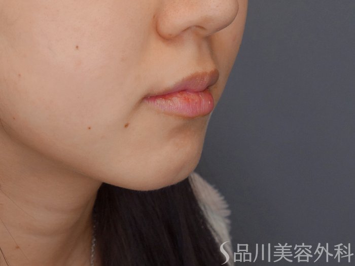 症例NO.69851のBEFORE写真