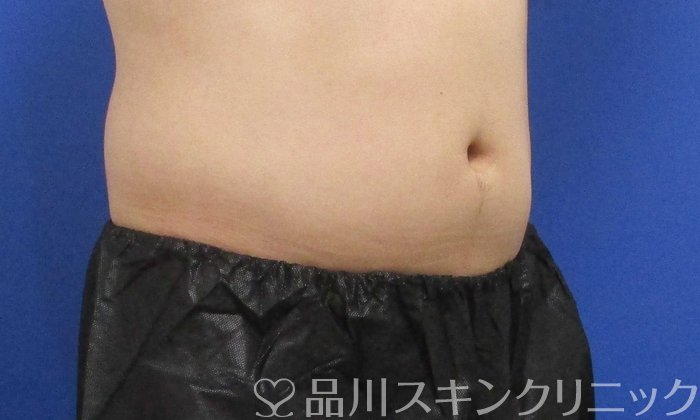 症例NO.70460のBEFORE写真