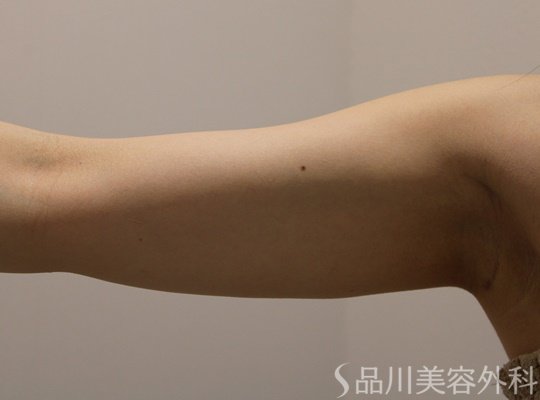 症例NO.70010のBEFORE写真