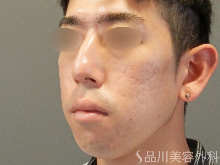 症例NO.67922のAFTER写真
