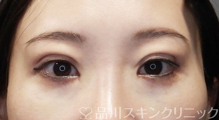 症例NO.72190のAFTER写真