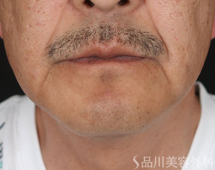 症例NO.71624のBEFORE写真
