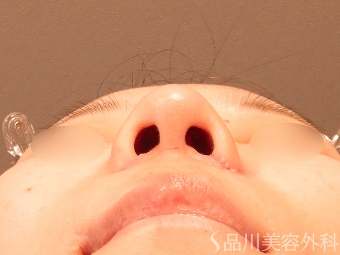 症例NO.70517のAFTER写真