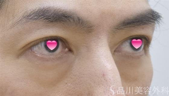 症例NO.51670のBEFORE写真