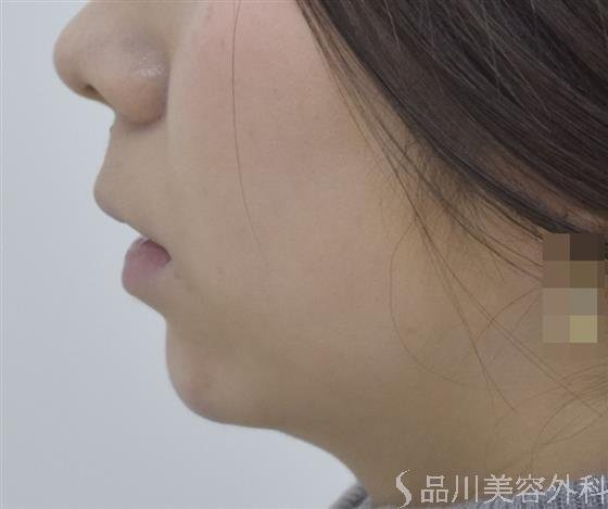 症例NO.46845のAFTER写真