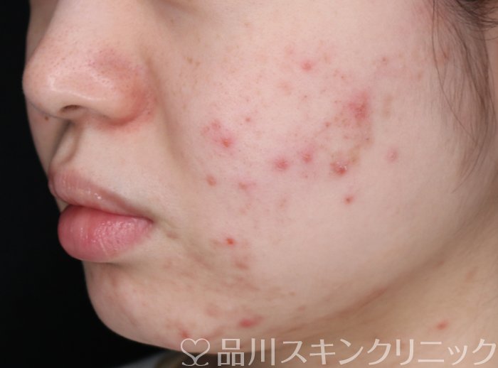 症例NO.74255のBEFORE写真