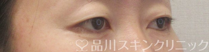 症例NO.70940のBEFORE写真
