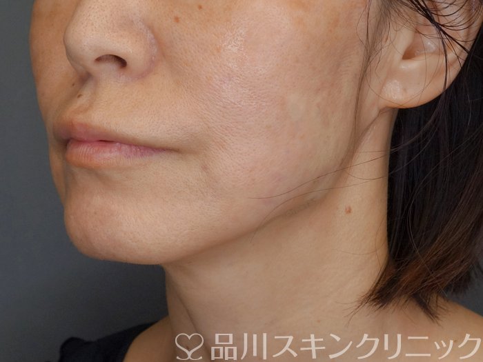 症例NO.71273のAFTER写真