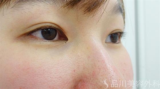 症例NO.36176のAFTER写真