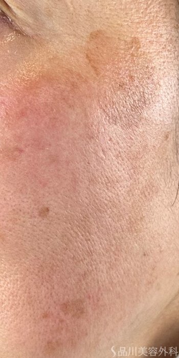 症例NO.72414のBEFORE写真