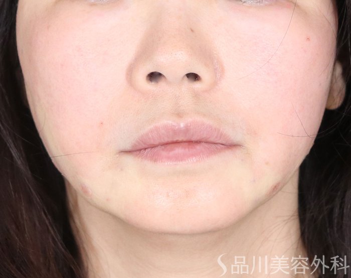 症例NO.72626のAFTER写真