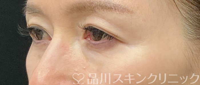 症例NO.75170のBEFORE写真
