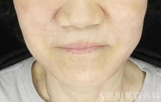 症例NO.65306のAFTER写真