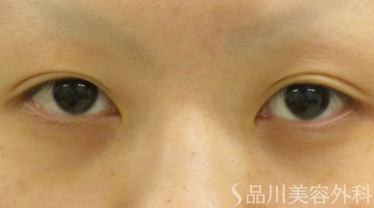 症例NO.62372のBEFORE写真