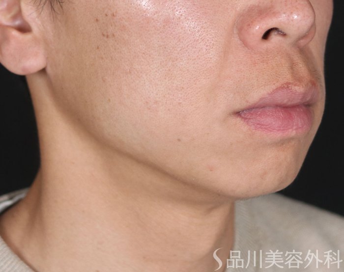 症例NO.73181のBEFORE写真