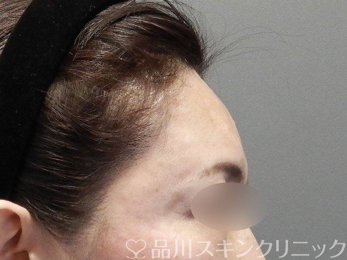 症例NO.74757のAFTER写真