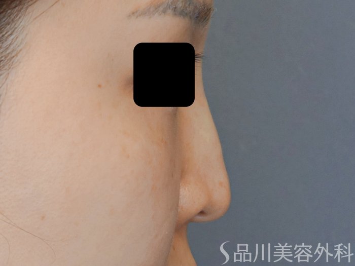 症例NO.70532のAFTER写真