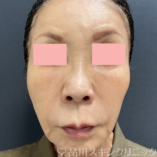 症例NO.71473のBEFORE写真