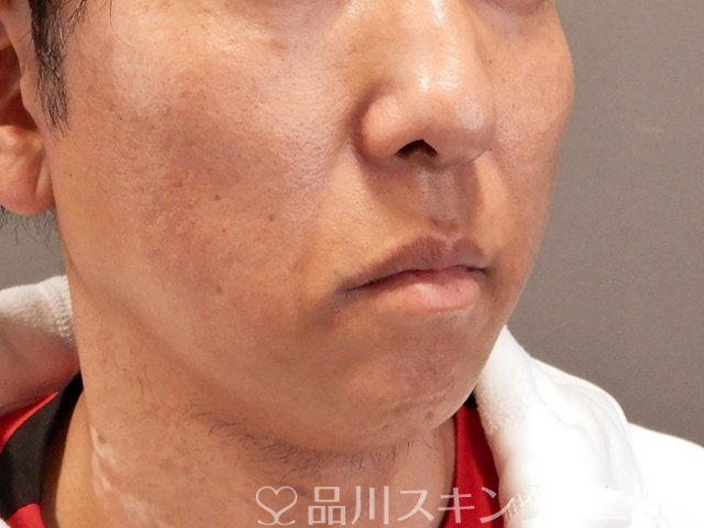 症例NO.70490のBEFORE写真