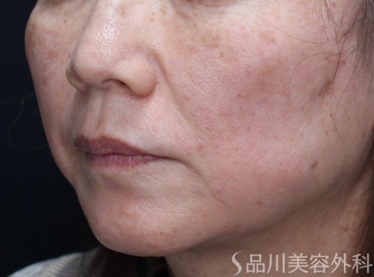 症例NO.72706のAFTER写真