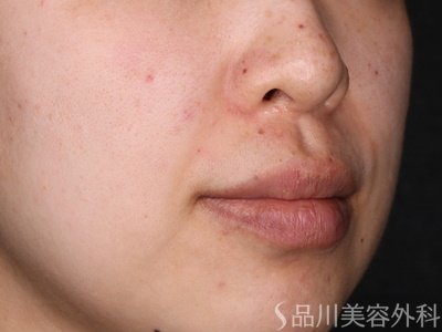 症例NO.73256のAFTER写真