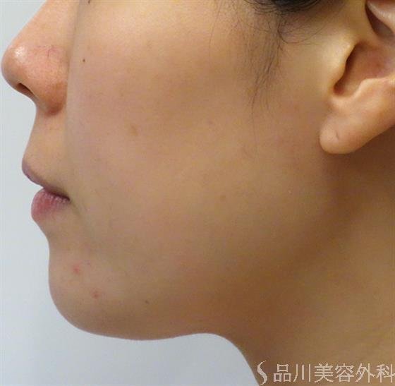 症例NO.47416のAFTER写真