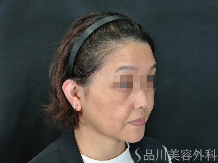 症例NO.70839のBEFORE写真