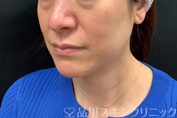 症例NO.71277のBEFORE写真