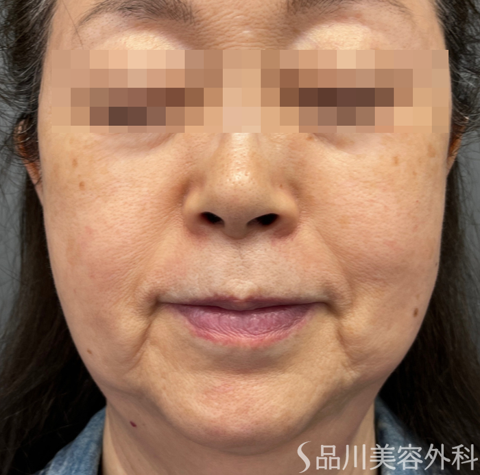 症例NO.65014のBEFORE写真