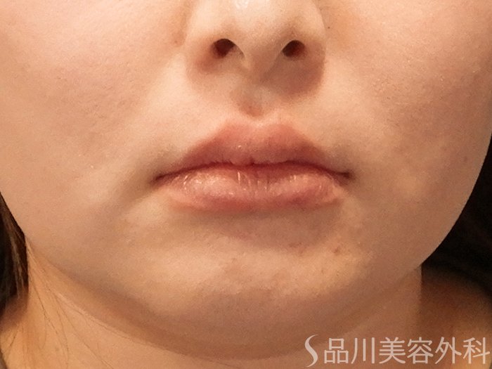 症例NO.69872のAFTER写真