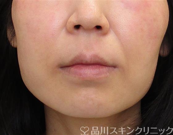 症例NO.59137のBEFORE写真