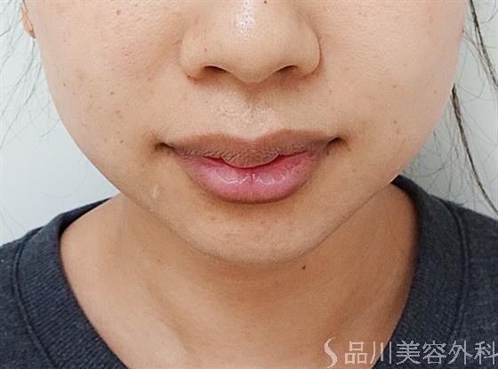 症例NO.44806のBEFORE写真