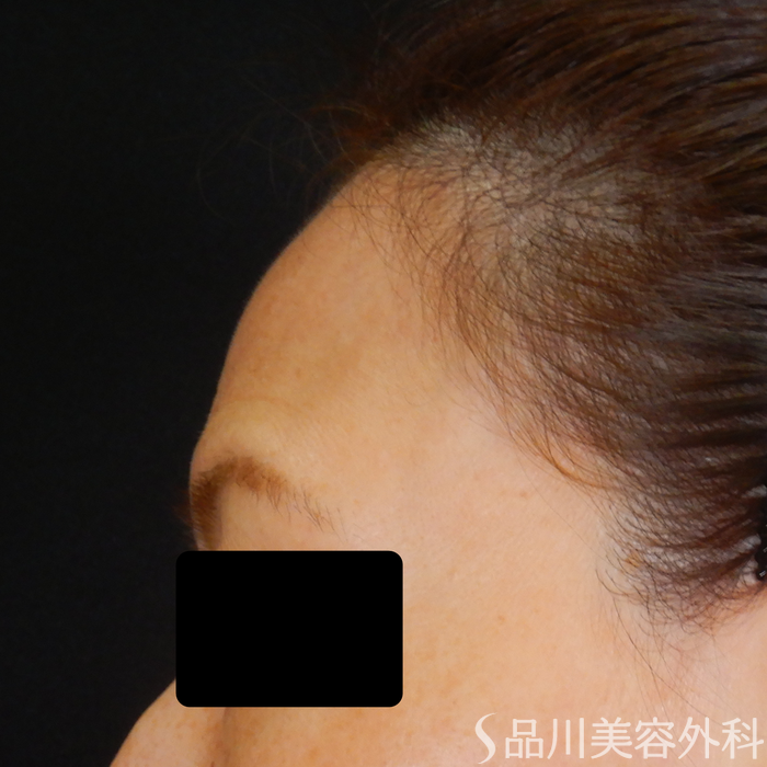 症例NO.69816のBEFORE写真