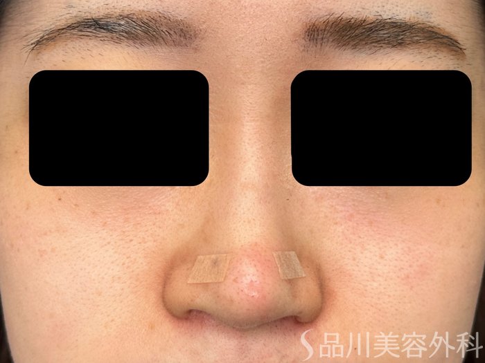 症例NO.74882のAFTER写真