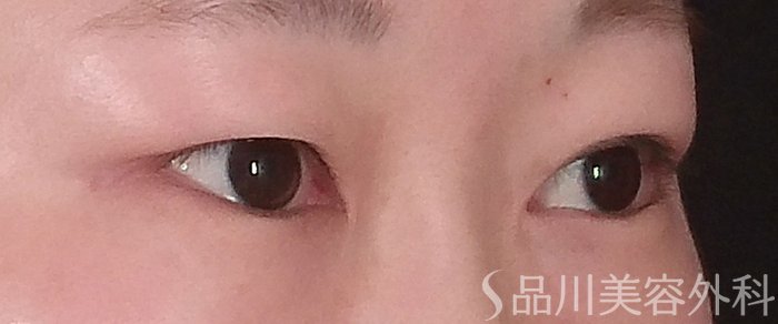 症例NO.69201のBEFORE写真