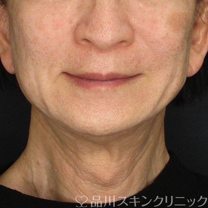 症例NO.74622のBEFORE写真