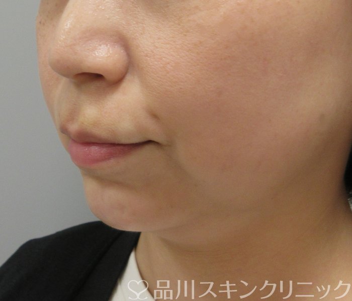 症例NO.70413のAFTER写真