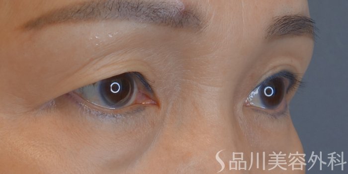症例NO.68309のBEFORE写真