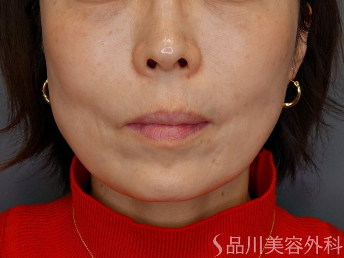 症例NO.73062のBEFORE写真