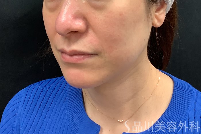 症例NO.71277のBEFORE写真