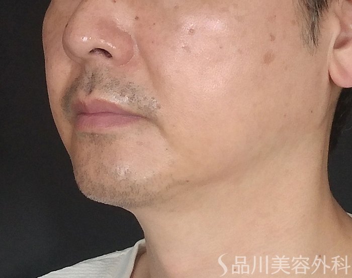 症例NO.65260のBEFORE写真